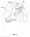 Fig. 02 - Medical system for annuloplasty