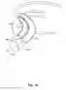 Fig. 05 - Medical system for annuloplasty