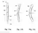 Fig. 12 - Medical system for annuloplasty