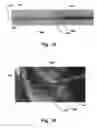Fig. 16 - Medical system for annuloplasty