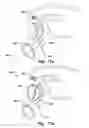 Fig. 17 - Medical system for annuloplasty
