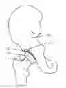 Fig. 01 - RESILIENT INTERPOSITIONAL HIP ARTHROPLASTY DEVICE
