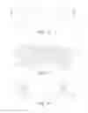 Fig. 15 - EXPANDABLE INTERBODY IMPLANT