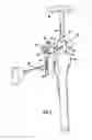 Fig. 11 - System for treating proximal humeral fractures and method of using the same