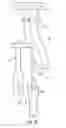 Fig. 17 - System for treating proximal humeral fractures and method of using the same