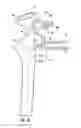 Fig. 24 - System for treating proximal humeral fractures and method of using the same