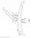 Fig. 02 - VASCULAR STENTING FOR ANEURYSMS