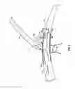 Fig. 07 - VASCULAR STENTING FOR ANEURYSMS