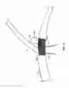 Fig. 15 - VASCULAR STENTING FOR ANEURYSMS