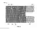 Fig. 16 - VASCULAR STENTING FOR ANEURYSMS