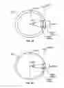 Fig. 21 - VASCULAR STENTING FOR ANEURYSMS