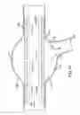 Fig. 30 - VASCULAR STENTING FOR ANEURYSMS