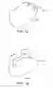 Fig. 12 - DEVICES AND SYSTEMS FOR GASTRIC VOLUME CONTROL