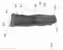 Fig. 23 - Intragastric device for treating obesity