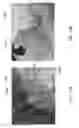 Fig. 35 - Intragastric device for treating obesity