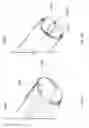 Fig. 48 - Intragastric device for treating obesity