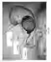 Fig. 54 - Intragastric device for treating obesity
