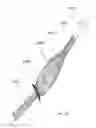 Fig. 56 - Intragastric device for treating obesity