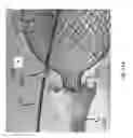 Fig. 82 - Intragastric device for treating obesity