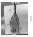 Fig. 83 - Intragastric device for treating obesity