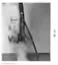 Fig. 84 - Intragastric device for treating obesity