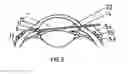 Fig. 04 - Methods and apparatuses for the treatment of glaucoma using visible and infrared ultrashort laser pulses