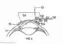 Fig. 05 - Methods and apparatuses for the treatment of glaucoma using visible and infrared ultrashort laser pulses