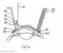 Fig. 07 - Methods and apparatuses for the treatment of glaucoma using visible and infrared ultrashort laser pulses