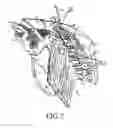 Fig. 08 - Methods and apparatuses for the treatment of glaucoma using visible and infrared ultrashort laser pulses
