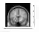 Fig. 03 - Botulinum Toxin for Primary Disorders of Mood and Affect using Neurotransmitter CNS imaging Studies