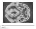 Fig. 04 - Botulinum Toxin for Primary Disorders of Mood and Affect using Neurotransmitter CNS imaging Studies