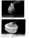 Fig. 04 - PLIABLE MEDICAL DEVICE AND METHOD OF USE