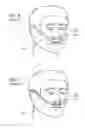 Fig. 05 - Methods, systems and devices for non-invasive open ventilation for treating airway obstructions