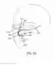 Fig. 13 - Methods, systems and devices for non-invasive open ventilation for treating airway obstructions