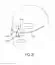 Fig. 15 - Methods, systems and devices for non-invasive open ventilation for treating airway obstructions