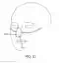 Fig. 17 - Methods, systems and devices for non-invasive open ventilation for treating airway obstructions