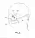 Fig. 22 - Methods, systems and devices for non-invasive open ventilation for treating airway obstructions