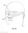 Fig. 23 - Methods, systems and devices for non-invasive open ventilation for treating airway obstructions