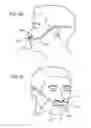 Fig. 30 - Methods, systems and devices for non-invasive open ventilation for treating airway obstructions