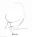 Fig. 36 - Methods, systems and devices for non-invasive open ventilation for treating airway obstructions