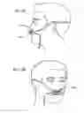 Fig. 66 - Methods, systems and devices for non-invasive open ventilation for treating airway obstructions