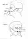Fig. 67 - Methods, systems and devices for non-invasive open ventilation for treating airway obstructions