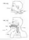 Fig. 70 - Methods, systems and devices for non-invasive open ventilation for treating airway obstructions