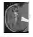 Fig. 06 - Enhanced spatial summation for deep-brain transcranial magnetic stimulation