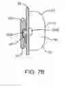 Fig. 09 - METHODS USEFUL FOR REMODELING MAXILLOFACIAL BONE USING LIGHT THERAPY AND A FUNCTIONAL APPLIANCE