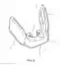 Fig. 14 - METHODS USEFUL FOR REMODELING MAXILLOFACIAL BONE USING LIGHT THERAPY AND A FUNCTIONAL APPLIANCE