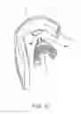 Fig. 20 - METHODS USEFUL FOR REMODELING MAXILLOFACIAL BONE USING LIGHT THERAPY AND A FUNCTIONAL APPLIANCE