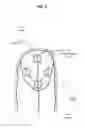 Fig. 03 - Use of light transmission through tissue to detect force