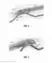 Fig. 04 - Methods and devices for vein harvesting