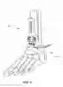 Fig. 03 - Methods and instruments for subchondral treatment of osteoarthritis in a small joint